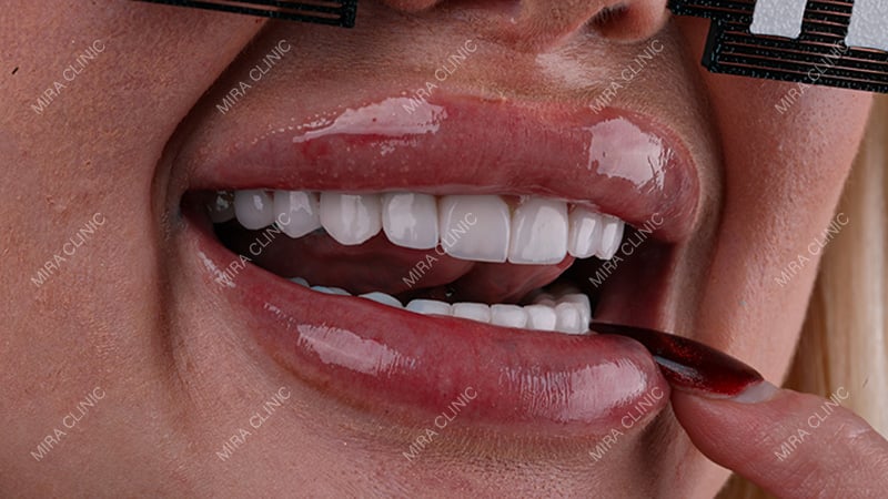 What to Know Before Getting Your Hollywood Smile